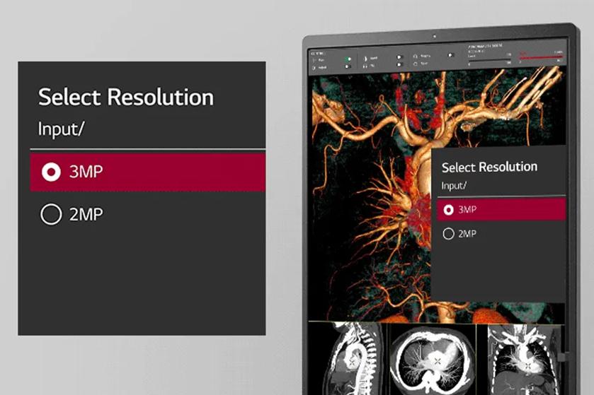 LG diagnostic monitor showing medical images with a resolution selection pop-up.