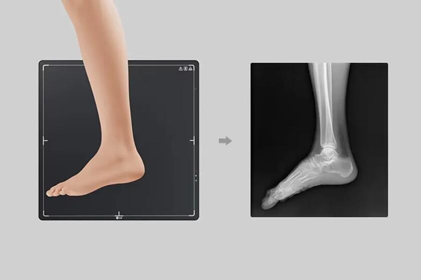 Illustration of a foot above a digital x-ray detector and the resulting x-ray image showing the foot's bones.