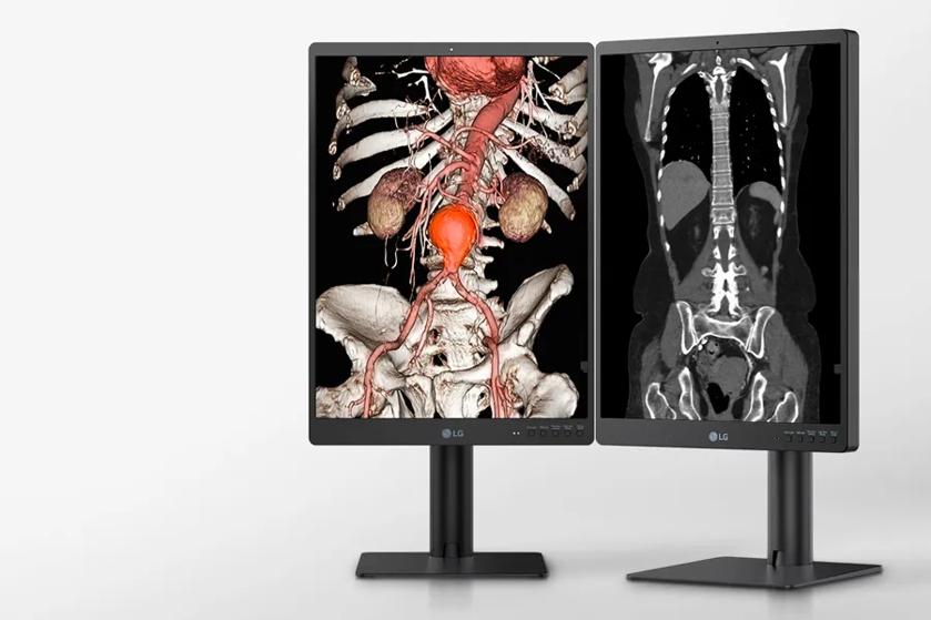 Two LG diagnostic monitors displaying a 3D anatomical image and a CT scan.