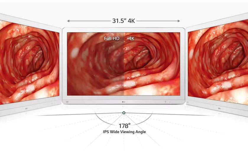 The image features three computer monitors displaying a vivid, detailed medical imagery depicting the interior of a human intestine. The monitors are positioned side-by-side, with the central monitor showcasing a comparison between "Full HD" on the left side and "4K" on the right, demonstrating a higher resolution with the latter. The 4K section appears clearer and more detailed, emphasizing its enhanced image quality. Above the central monitor, there are annotations indicating the screen size “31.5” and resolution “4K.” Below the monitors, text highlights “178° IPS Wide Viewing Angle,” indicating that the monitors offer a wide viewing angle.