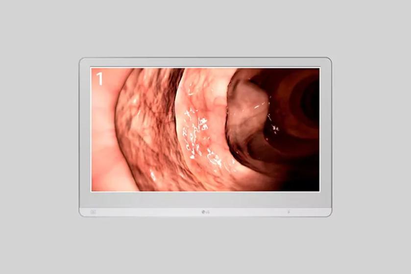 Computer monitor showing an endoscopic image of a human body cavity