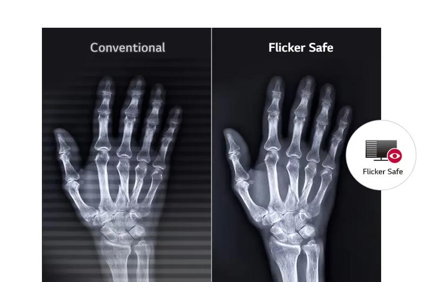 Comparison of hand X-ray images under "Conventional" and "Flicker Safe" settings.