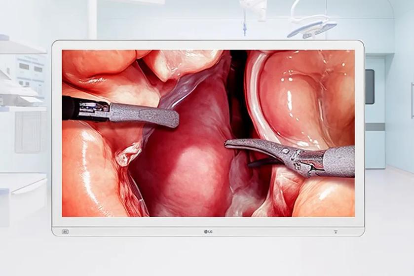 Monitor displaying a surgical procedure in an operating room.