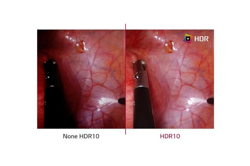 The image presents a side-by-side comparison of imagery from a medical procedure, captured with different imaging techniques. On the left, labeled "None HDR10," the image appears somewhat dark with less defined details. On the right, labeled "HDR10," the image is clearer and brighter, enhancing the visibility of the fine details in the tissue structure. The image separation line in the middle highlights the difference between the two techniques. There is a logo in the top right corner of the right image, reading "HDR" with a colorful design.