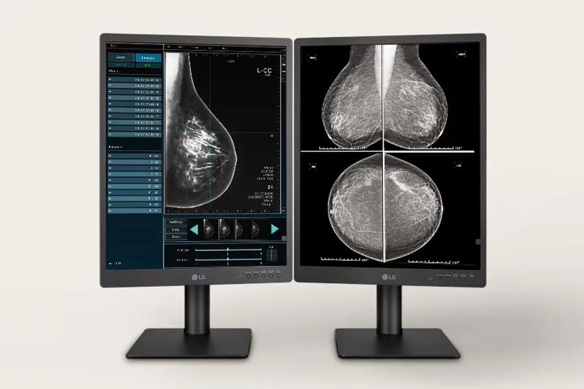 Two LG diagnostic monitors displaying mammogram images.