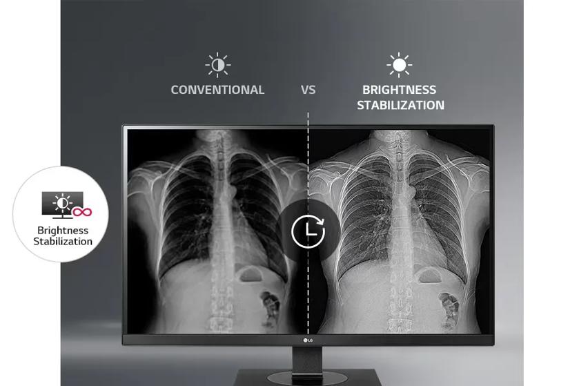 LG monitor showing a comparison of X-ray images with conventional vs. brightness stabilization.