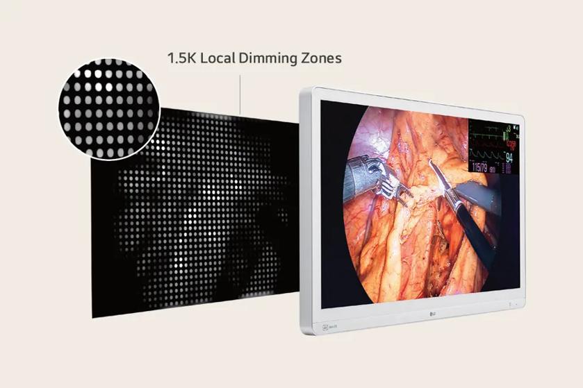 A monitor displays a surgical scene and vitals, with a local dimming zones graphic to the left.

Transcribed Text:

1.5K Local Dimming Zones