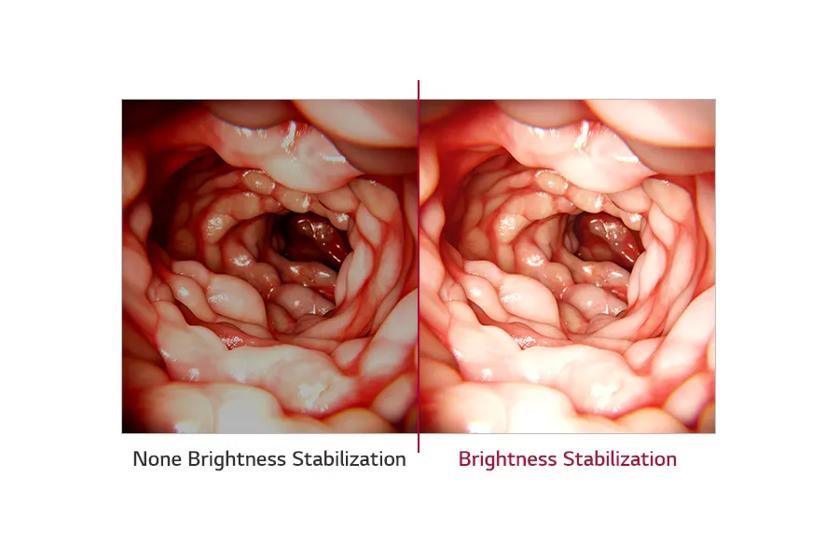 The image is split into two equal sections. On the left is an endoscopic view labeled "None Brightness Stabilization," showing an image inside a bodily organ. The texture is slightly darker with less contrast, giving it a more shadowed appearance. On the right, the section labeled "Brightness Stabilization" displays a similar endoscopic view but with enhanced brightness and contrast, making tissue structures more distinct and visible. 