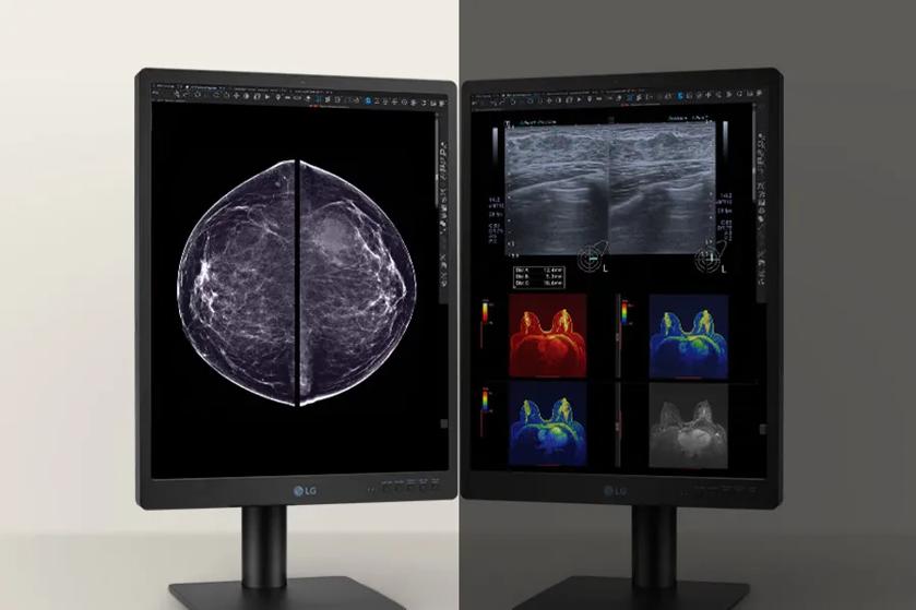 Two LG diagnostic monitors displaying mammogram and sonogram images, the left side bright in a well-lit area and the right side with brightness adjusted for a darker area.
