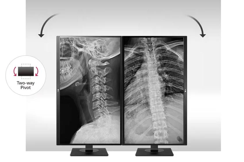 Two LG clinical monitors displaying X-rays with a two-way pivot feature.