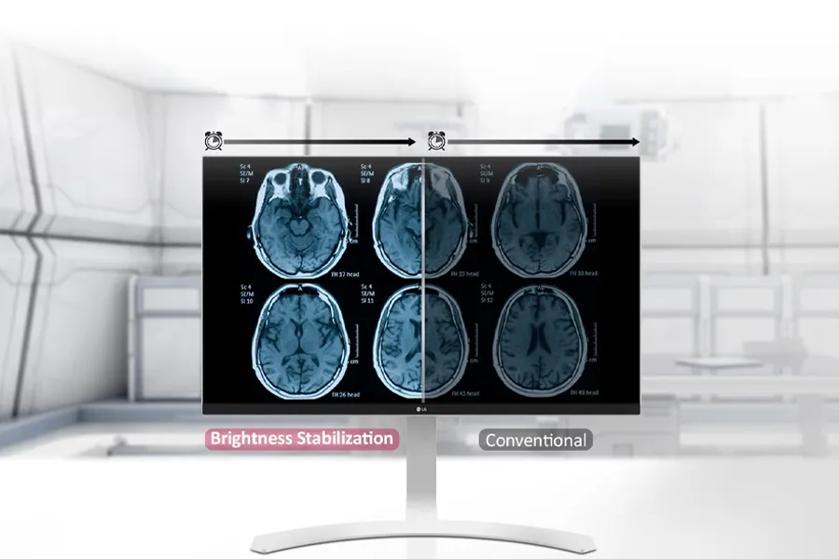 The image displays a computer monitor in a clinical setting. The monitor shows a series of brain scans split into two sections. On the left, the "Brightness Stabilization" section consists of three MRI images of the brain, appearing clearer and brighter than those on the right. On the right, labeled "Conventional," three similar MRI images are shown, but they appear slightly darker and less distinct. 