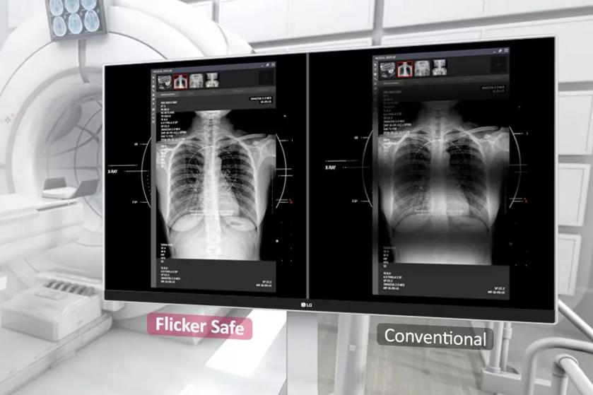 The image shows a medical imaging room featuring a large monitor displaying two chest X-ray images side by side. The left side is labeled "Flicker Safe" and the right side "Conventional".  The flicker safe side is clear and visible, while the convention portion has dark lines to represent monitor flickering. Behind the monitor is imaging equipment, such as a CT or MRI scanner, with visible control panels and a sterile white environment.