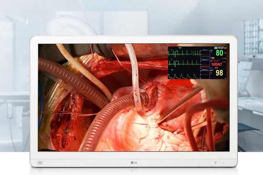 LG surgical display showing open-heart surgery with vital signs overlay.