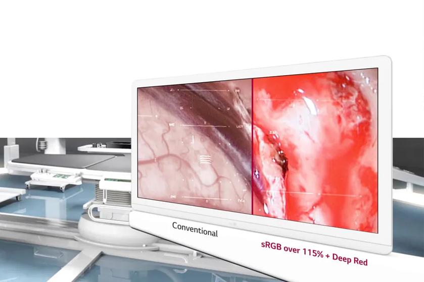 The image shows a sleek, modern medical display monitor in a clinical setting. The screen is divided into two halves. The left half showcases an image with muted and less vibrant colors labeled as "Conventional," displaying anatomical features with a subdued red-pink hue and visible vascular patterns. The right half, labeled "sRGB over 115% + Deep Red," presents a more vivid and saturated view of the same anatomical subject, highlighted by intense red tones. Behind the display, there is a blur of advanced medical equipment and machinery, suggesting a high-tech operating room environment.